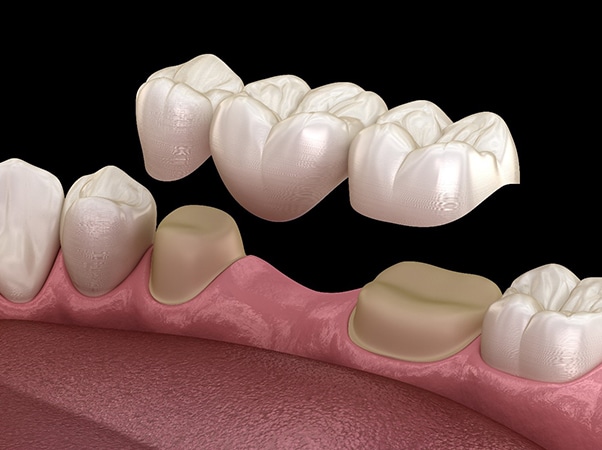 Digital illustration of dental crowns and implants on pink gum model showing tooth restoration options.