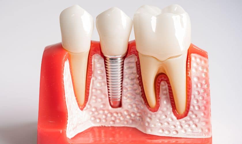 Dental Implant in Santa Fe